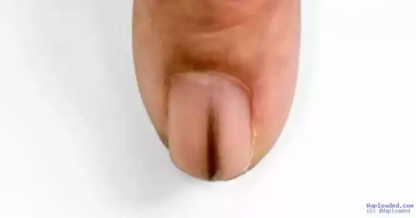 If This Appears On Your Nail It Is Time To See A Doctor …